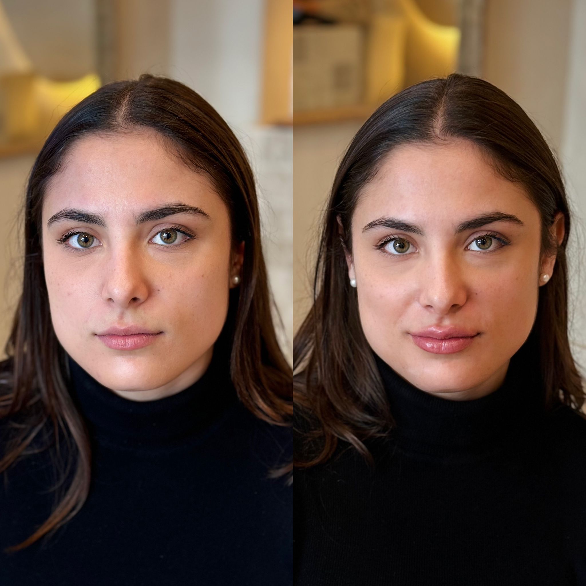 Ácido hialurónico labios valencia - antes y después 2