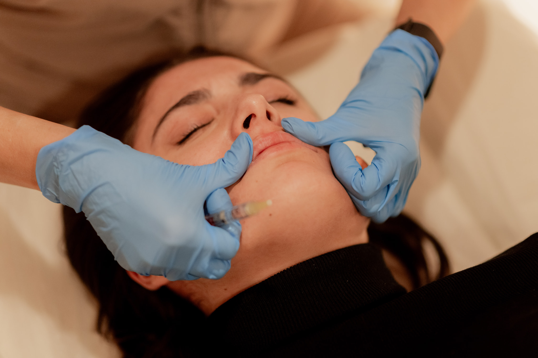 Tratamiento de hacido hualironico labios valencia medicina estética