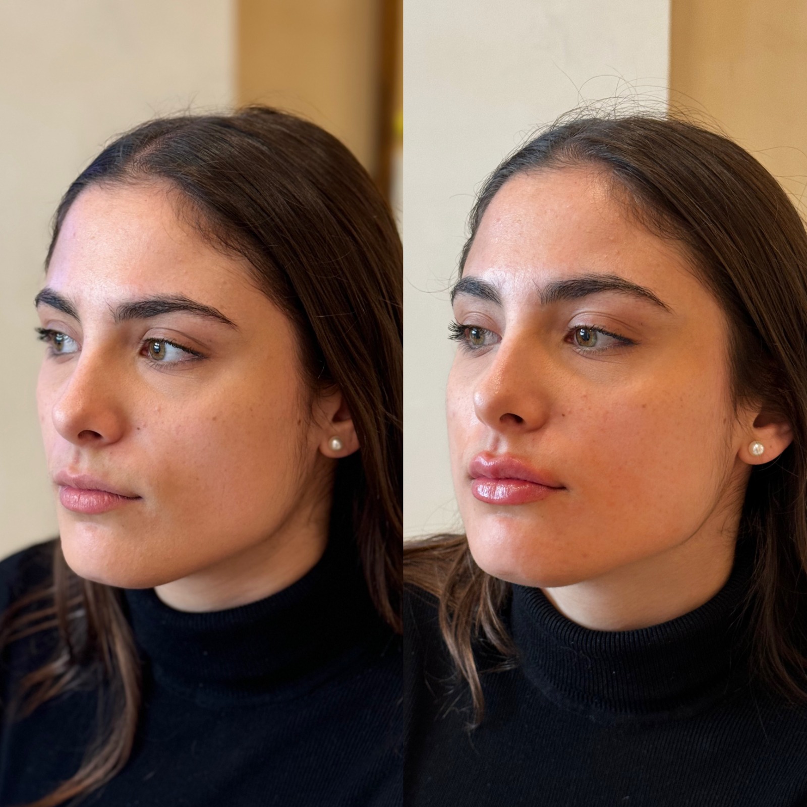 Ácido hialuronico labios valencia - antes y después